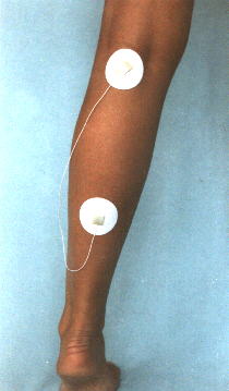 Muskelh�rten in der Wade